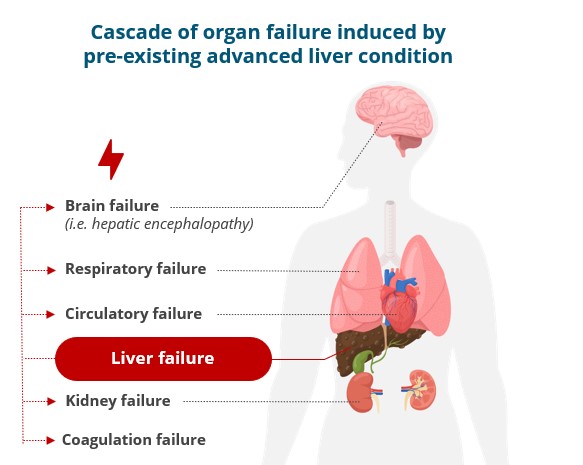 2024.04 schémas ACLF 2 EN.jpg